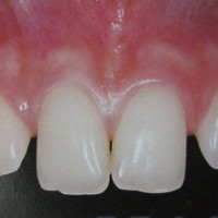 Công thức cho nụ cười hoàn hảo