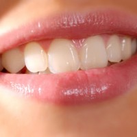 Răng sứ loại nào tốt nhất