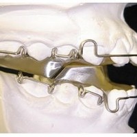 Niềng răng móm không cần phẫu thuật More Sharing Services