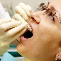 Ai cần Niềng Răng