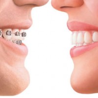 Chỉnh Nha Và Những Điều Cần Biết