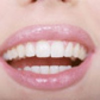 Hậu thẩm mỹ răng