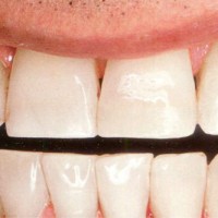 Bạn có biết cách cải thiện nụ cười của mình