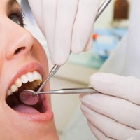 Những điều cần biết về cạo vôi răng