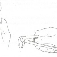 Nhổ răng bằng kìm