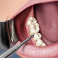 Khi Nào Phải Nhổ Răng