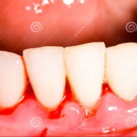 Chảy máu nướu răng: đừng xem nhẹ