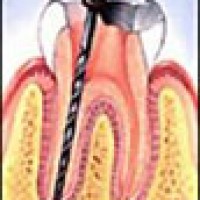 Hạn chế lấy tủy răng trong điều trị nha khoa