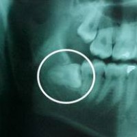 Lưu ý sau khi nhổ răng khôn