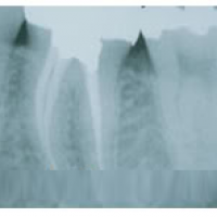 Quy trình nội nha – Chữa tuỷ răng