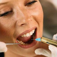 Lời khuyên của BS RHM đối với bệnh nhân nhổ răng