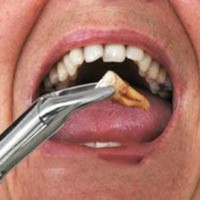 Nhổ răng hàm không đau