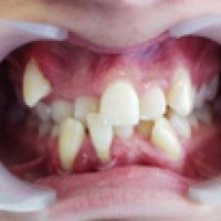 Các trường hợp cần nhổ răng