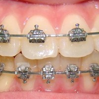 Những chú ý khi niềng răng