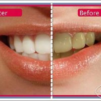 Tại sao cạo vôi răng bị ê răng và đau nướu? Tại sao nên cạo vôi răng định kỳ