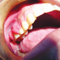 PHÒNG NGỪA VÀ ĐIỀU TRỊ BỆNH NHA CHU