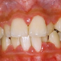 Bệnh nha chu không chỉ gây mất răng