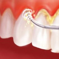 Cạo vôi răng có đau không