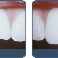 Khi nào cần trám răng