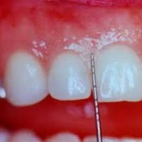 Bệnh nha chu là gì