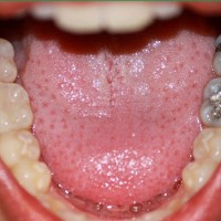 Khi nào cần trám răng và vật liệu trám răng nào tốt nhất