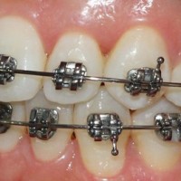 Làm gì khi răng mọc chen chúc