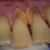 Cạo vôi răng và xử lý chân răng giúp răng và miệng của bạn sạch sẽ