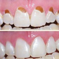 Trám răng có đau không