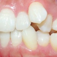 Vì sao răng mọc chen chúc