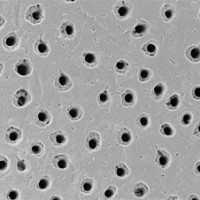 Điều gì gây ra hiện tượng ê buốt răng