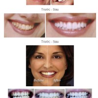 Răng sậm màu và các biện pháp cải thiện