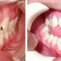 NGUYÊN NHÂN VÀ TÁC HẠI CỦA RĂNG MỌC CHEN CHÚC