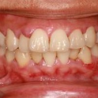 NGUYÊN NHÂN GÂY CHẢY MÁU NƯỚU VÀ CÁCH CHỮA TRỊ