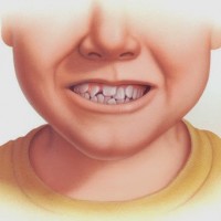 Niềng răng cho vấn đề răng mọc chen chúc