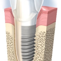 Kiến thức phổ thông về Implant