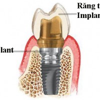 Chăm sóc răng sau khi đặt Implant