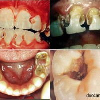 Nhiễm trùng răng