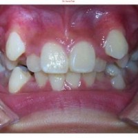 Chỉnh nha cho trường hợp răng mọc chen chúc