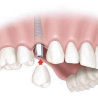 Cấy ghép răng implant có đau không