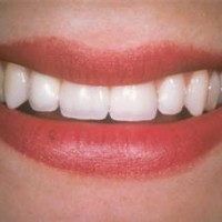 Những ai không nên cấy ghép răng implant