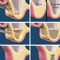 Kỹ thuật hỗ trợ cấy ghép Implant