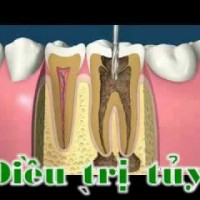 Lưu ý khi điều trị tủy