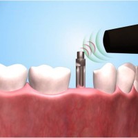 Phục hình tức thì trên Implant