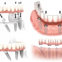 All on 4 và All on 6 cho mất răng toàn hàm
