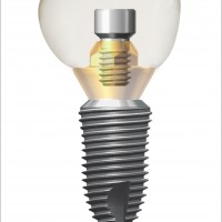 Hệ thống Implant sử dụng