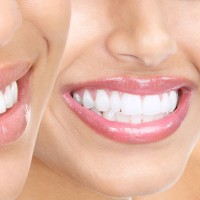 Cấy Implant tức thì sau nhổ răng