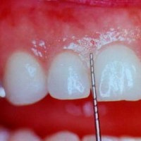 PHÒNG NGỪA VÀ ĐIỀU TRỊ BỆNH NHA CHU