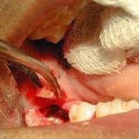 NHỔ RĂNG PHẪU THUẬT NHỮNG RĂNG KHÓ