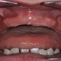 Tổng quát về Bệnh nha chu