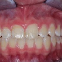 Một số hình ảnh tham khảo trước và sau khi điều trị chỉnh nha Phần 1